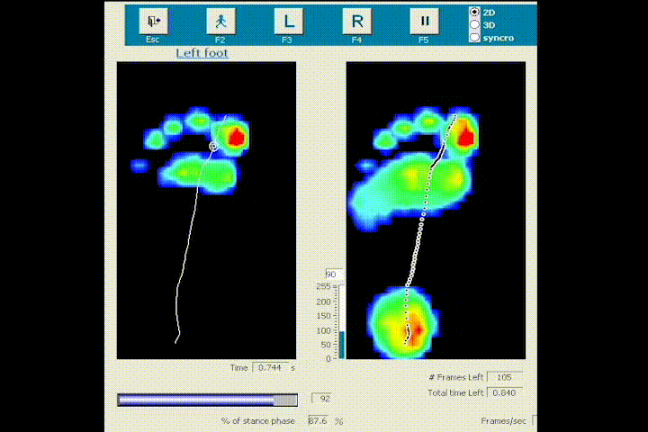 2D FootScan Pressure Map